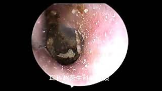 耳內鏡：清理外耳道耵聍Endoscope to clean the external auditory canal