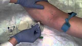 Phlebotomy on Live Patient Straight Needle