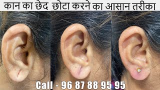 Earlobe/Hole Repair By Ear Pasting lotion/Ear Pasting Lotion Available Torn Ear lobe/Call-9687889595