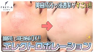 【美容成分の浸透率がすごい！】エレクトロポレーションをご紹介