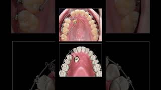 How to pull teeth underground when braces?