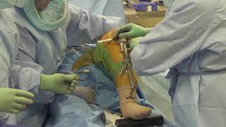 Partial Knee Replacement with Dr. Sridhar Durbhakula