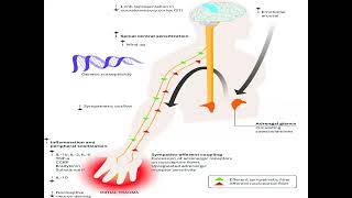 Complex regional Pain Syndrome by Dr Sidra Javed