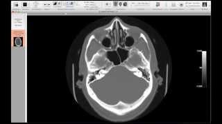 Christopher Hess, MD, PhD, Neuroimaging Part 2: Fundamentals of Image Interpretation