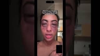 Allergy life😅 (don’t worry, I’m fine. I was clearing my old videos and found this😂)
