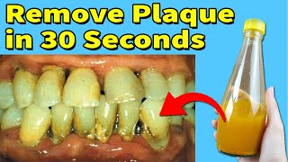 Remove Plaque And Tartar In 30 Seconds With This Mixture - Only 3 Ingredients