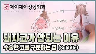 돼지코가 안되는 이유 feat. 수술한 코를 구분하는 법  - 제이제이성형외과