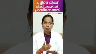 പല്ലിലെ വിടവ് നികത്തലിനുശേഷം ശ്രദ്ധിക്കേണ്ടത്‌ #Shorts #dentalcare #toothgay #Aftertoothgapfilling