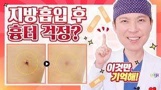 걸그룹 흉터/흉터 치료/성형수술 흉터, 홍닥터가 알려주는 성형수술 후 흉터 안남기는 방법?!(SUB) Scar from plastic surgery / Scar treatment