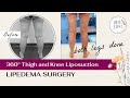 360° Thigh & Knee Liposuction | Lipedema Surgery | Expert Dr. Thomas Su | Artlipo