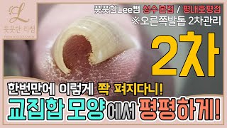 교집합 모양에서 평평한 발톱으로! 한번만에 이렇게 펴질수있다니!😎 ingrown toenail - Fresh Foot 풋풋한리쌤 성수점 / 평내호평점