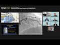 [TCTAP 2022] Coronary Live Case Session 2: COMPLEX PCI