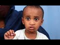 फांक होंठ की सर्जरी के बाद बच्चे को मिला निशान मुक्त परिणाम bilateral cleft lip surgery in india