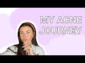 Hormonal Acne Journey with Jensen Arnold! *Super Vulnerable*