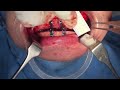 redo jaw surgery with silicon augmention done in usa few years ago