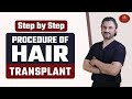 Hair Transplant Procedure Step by Step | Hair Transplant in India | Crown Hair Transplant