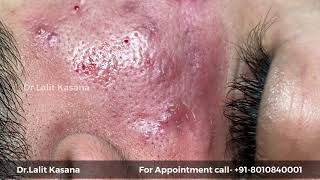 Blackhead Removal by Dr.Lalit Kasana (22 Dec. 2019)