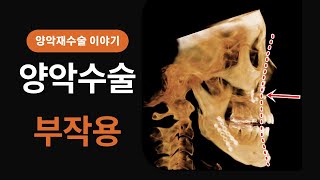 [닥터봉TV_CBK성형외과_최봉균]양악수술 부작용 코골이 긴얼굴 교정을 위한 양악재수술 후기[CBK整形外科_チェ·ボンギュン] 両顎手術の副作用 いびきと面長矯正のための両顎再手術レビュー