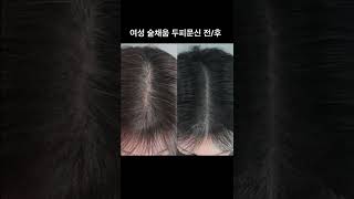 휑하게 비어 보이던 가르마, 자연스럽게 커버 완료! #shorts #두피문신 #scalpmicropigmentation #smp #탈모