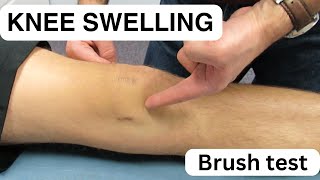 Knee Swelling The Brush Test
