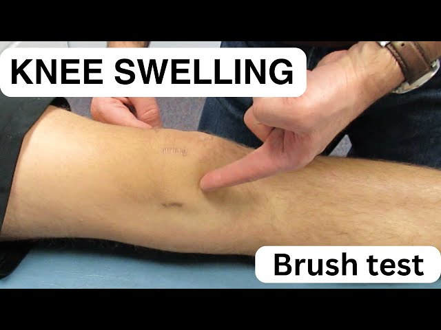 Knee Swelling Knee Swelling 3 Months After Meniscus Surgery Dr