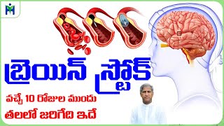 BRAIN STROKE వచ్చే 10 రోజుల ముందు తలలో కనిపించే లక్షణాలు | Dr Manthena Satyanarayana Raju Videos