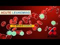 Acute Leukemias