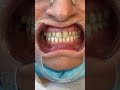 dental fluorosis and dental veneers