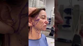Watch Her Age In Reverse Facelift