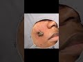 A deceivingly cheeky cyst ✌️❤️💥 #drpimplepopper #popaholics #oddlysatisfying