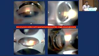 AIOCMT3 2024   GP40 topic   Dr Satyabrata  Tripathy CHANDLERS SYNDROME  A CASE REPORT