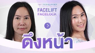 รีวิวดึงหน้า Facelift บุก iconsiam กินเนื้อวากิว หลังดึงหน้าไปยังไม่ถึง 24 ชม. พี่หม่อนอายุ 50 ปี