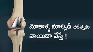 What happens Delay Knee Replacement - explained by Dr. Radhakrishna Rao Sagi, Orthopaedic Surgeon