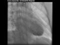 Takotsubo Cardiomyopathy Caught on Tape