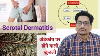 अंडकोष पर होने वाली खुजली का कारण - Part 1 Scrotal Dermatitis | Scrotal Eczema #scrotaldermatitis