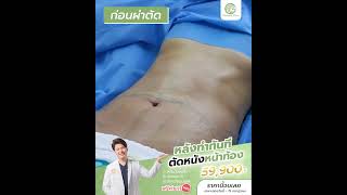 EP.02_รีวิว_ตัดหนังหน้าท้อง_Cosmetica Clinic