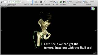 Pelvic fracture - How to delete the femoral head on Horos