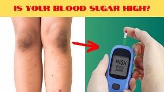 13 ALARMING Signs Your Blood Sugar Is HIGH!