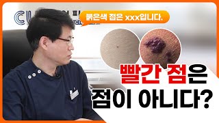 점(모반)의 색깔은 정해져있다? 빨간점은 무엇일까요? 피부과전문의가 알려주는 점 종류 및 점 제거 레이저