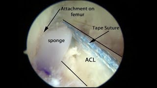 PRESERVE ACL Surgery