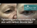 Tightening and rejuvenating the skin with carbon dioxide laser (20185)