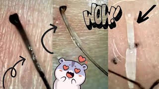 Super Satisfying Juicy Hair Follicle Plucks! Ingrown Hair Removal Under Microscope - BIG ROOTS!