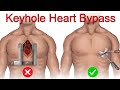 Heart Bypass Without Breaking Bone: The Revolutionary Treatment You Need To Know About