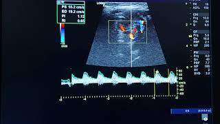 carotid body tumor ultrasound