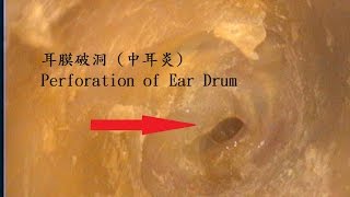 中耳炎 耳膜破洞  COM, right ear,  perforation of ear drum