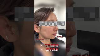 波士顿医美｜AeLeeMD爱丽医美美丽变身！下颌缘管理不只是【紧致】那么简单，调整三庭比例、消脂、调整咬肌大小和调整颈阔肌活动度等缺一不可，热玛吉/超声刀/轮廓固定/下颌缘提升/瘦脸针，根据需求选择