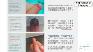 【見證分享】丹麥小孩使用LIFEWAVE貼片斷指復原，傷口癒合 (附中文字幕)