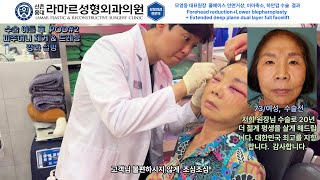 모영웅 대표원장님 풀페이스 안면거상 수술 결과 (수술 2일차) (Extended deep plane dual layer full facelift)