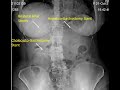 Bilateral Metal Stenting + EUS guided Hepaticogastrostomy and Cholecystogastrostomy for type 4 block