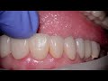 Dr. Abdi Sameni Demonstrates G-CEM LinkAce®